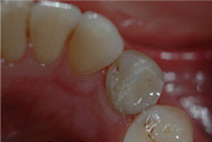 Amalgam Removals After