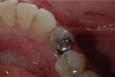 Amalgam Removals Before